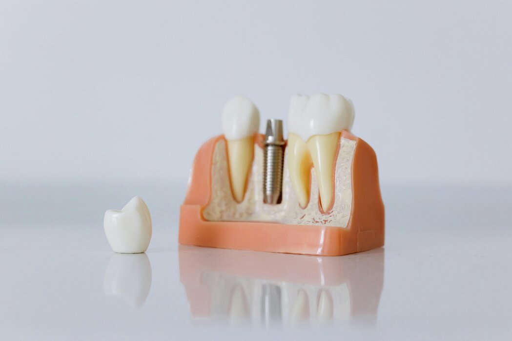 Dental crown model illustrating major services